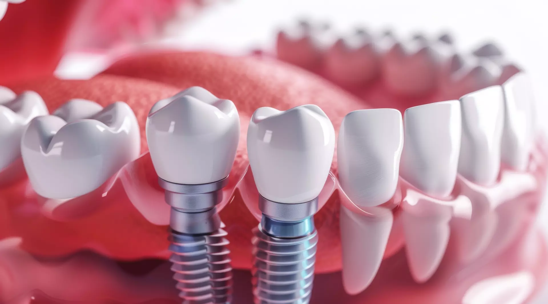 Dental Implants